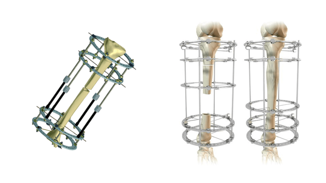 Ilizarov Technique for Limb Lengthening