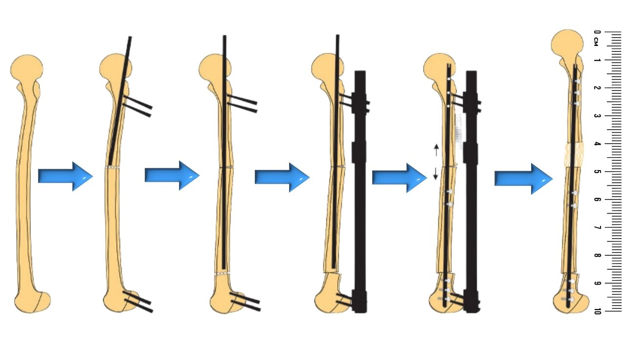 Fixator-Assisted Nailing (FAN) for Limb Lengthening