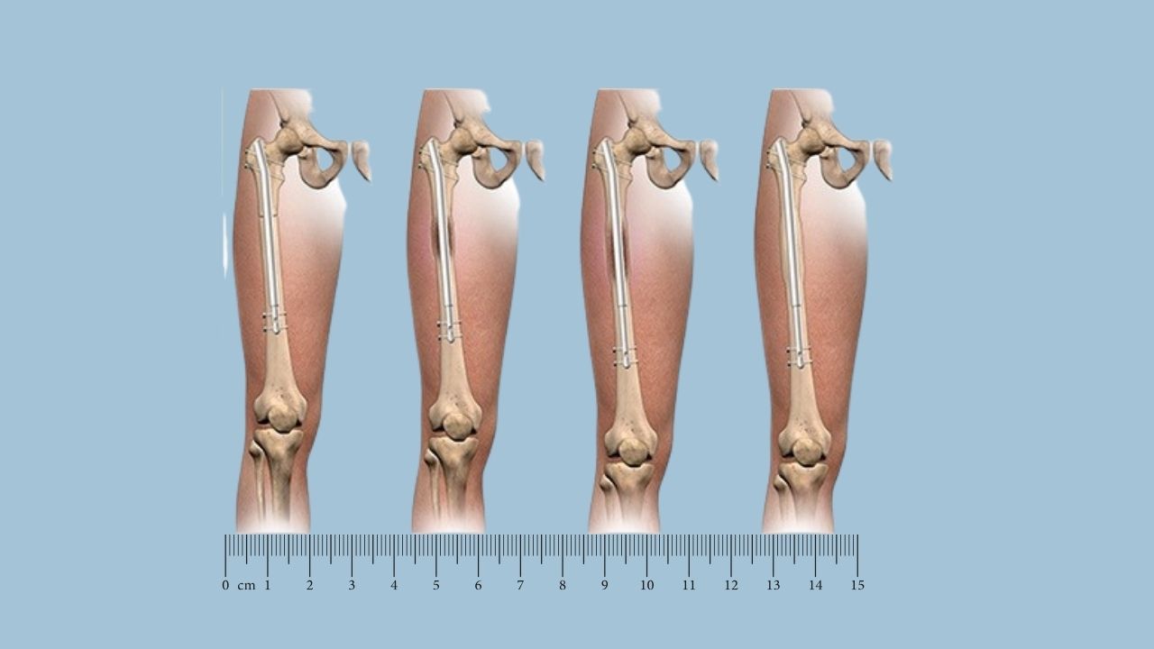 PRECICE Nail (Internal Lengthening Nail) for Limb Lengthening