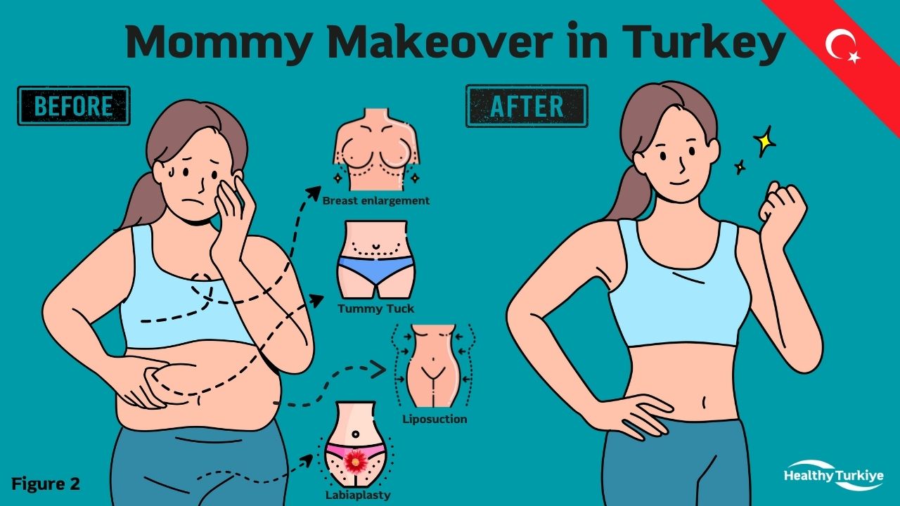 Mommy Makeover in Turkey