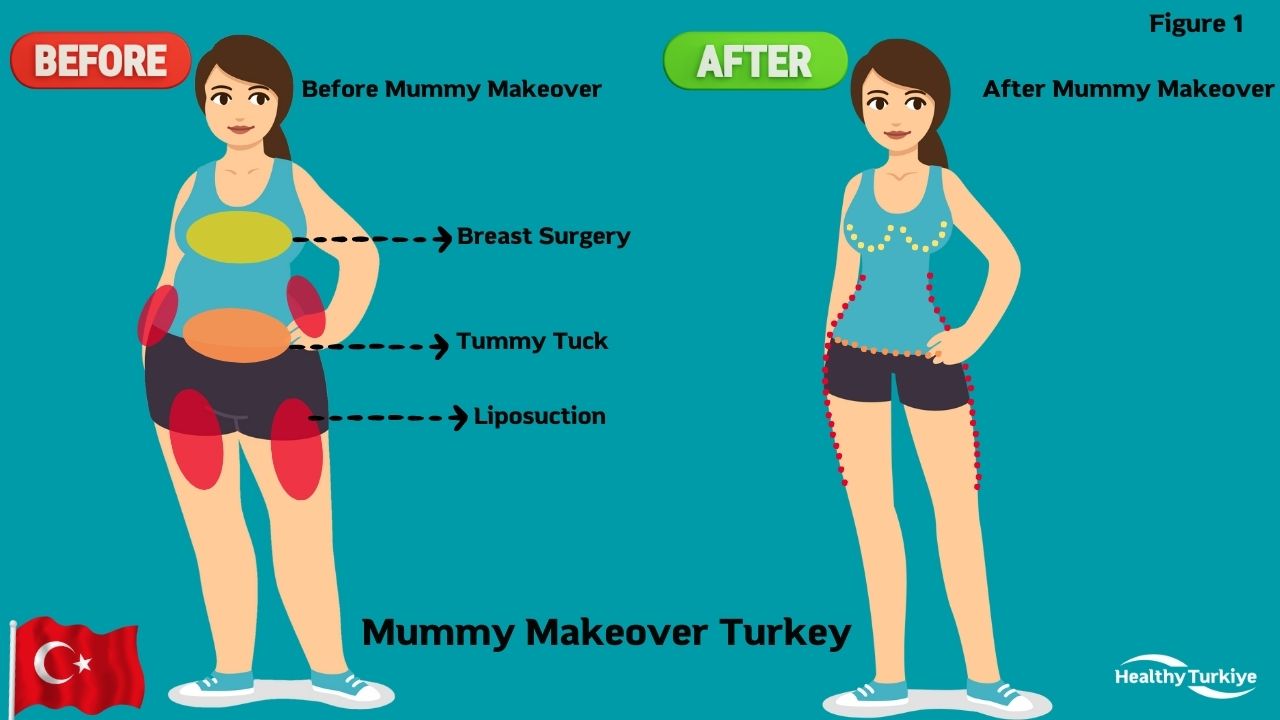 Mummy Makeover Turkey