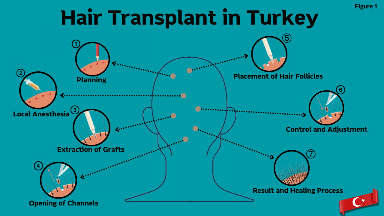 Hair transplant in turkey procedure