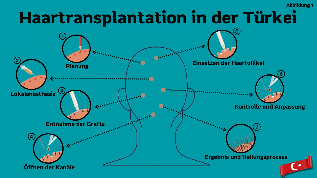 Haartransplantation turkei