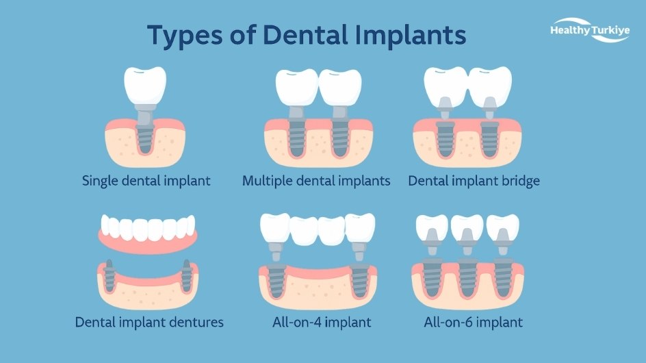 Turkish dental implant