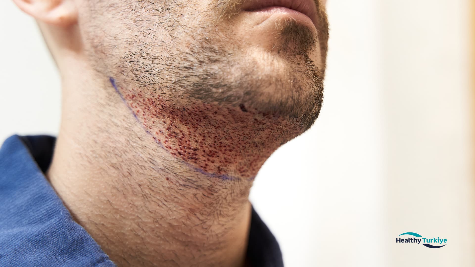 What to Do Before a Beard Transplant in Turkey?