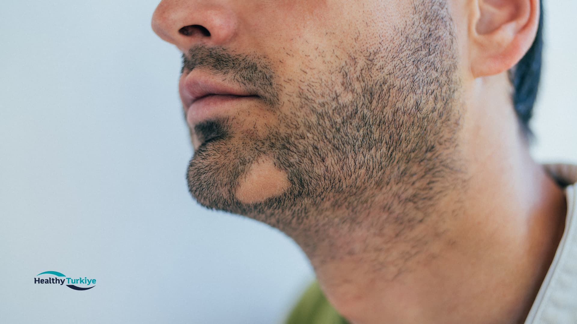 Beard Transplant Types in Turkey