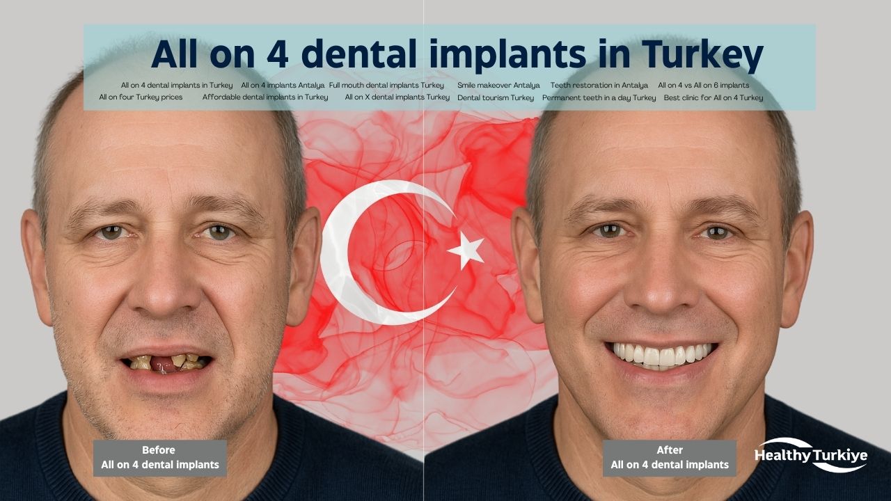 All on four in Turkey All on four in Turkey