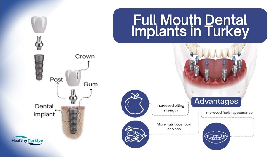 Full mouth dental implant turkey Full mouth dental implant turkey