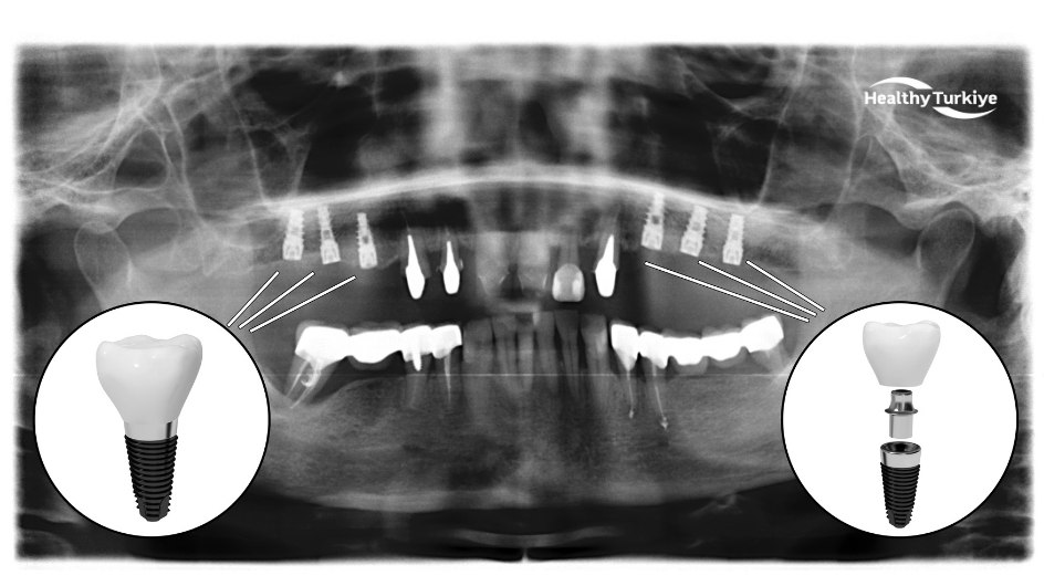 Full set mouth dental implant turkey Full set mouth dental implant turkey