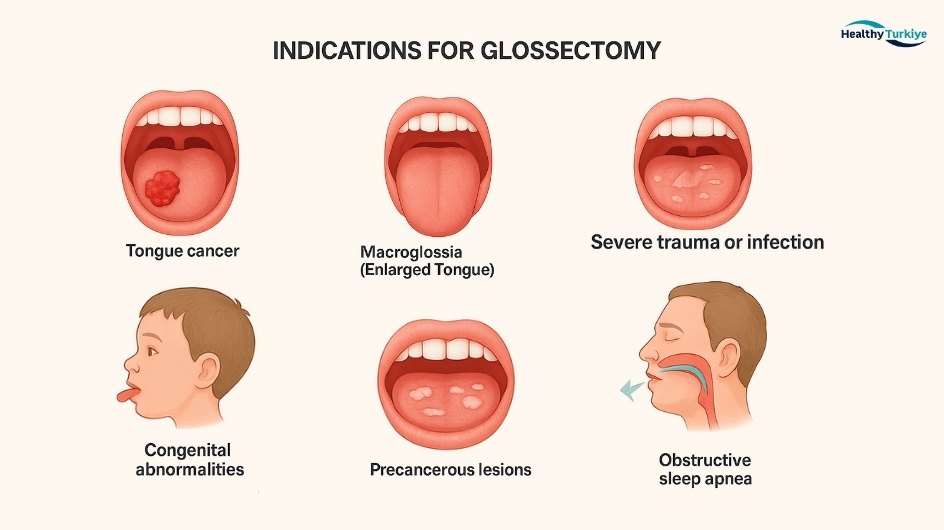 Glossectomy turkey Glossectomy turkey