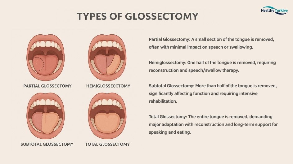 Glossectomy turkiye Glossectomy turkiye