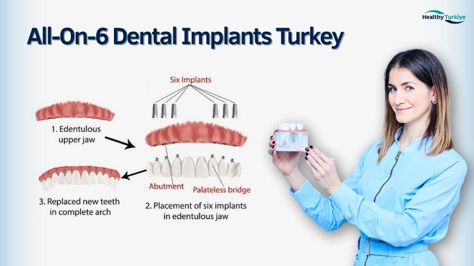 All on 6 dental implant in turkey All on 6 dental implant in turkey