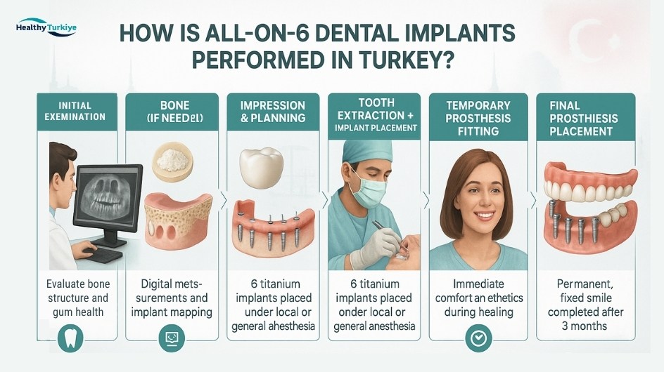 All on 6 dental implant turkiye All on 6 dental implant turkiye