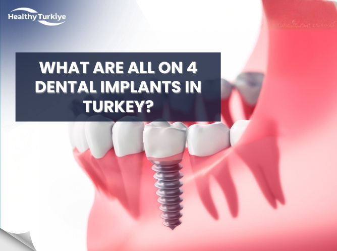 What Are All on 4 Dental Implants in Turkey? Full Guide