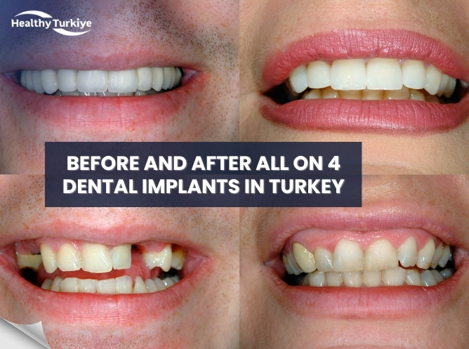 Before and After All on 4 Dental Implants in Turkey