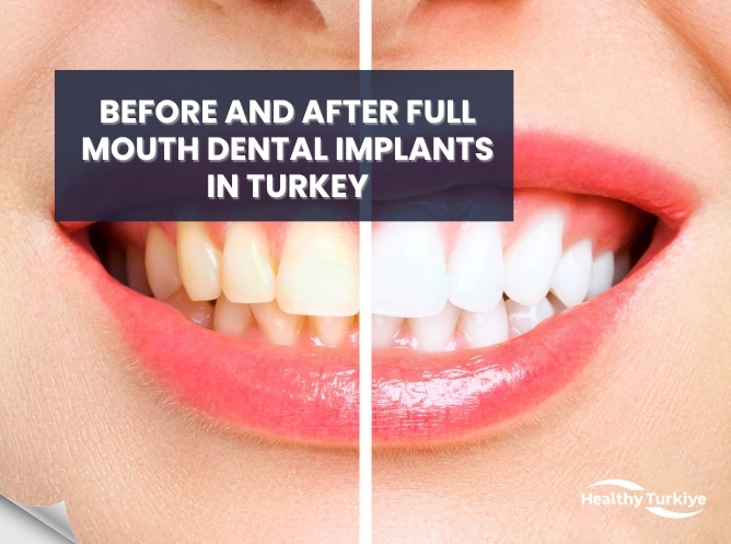 Before and After Full Mouth Dental Implants in Turkey
