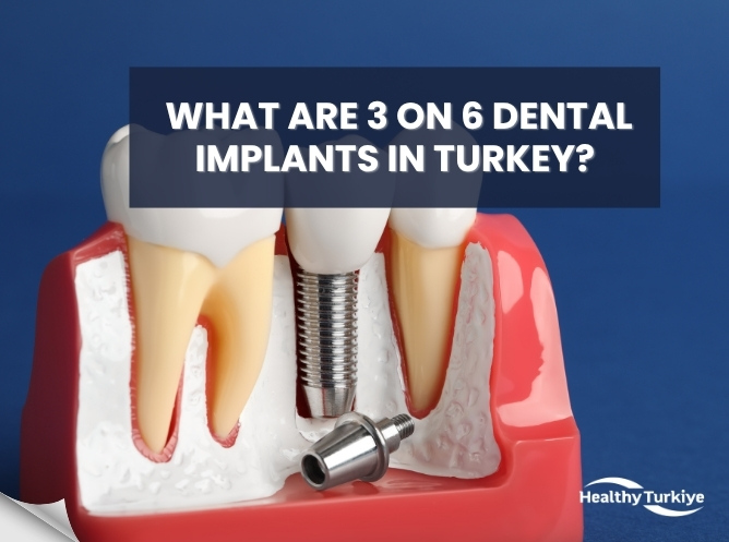 What Are 3 on 6 Dental Implants in Turkey? Full Guide