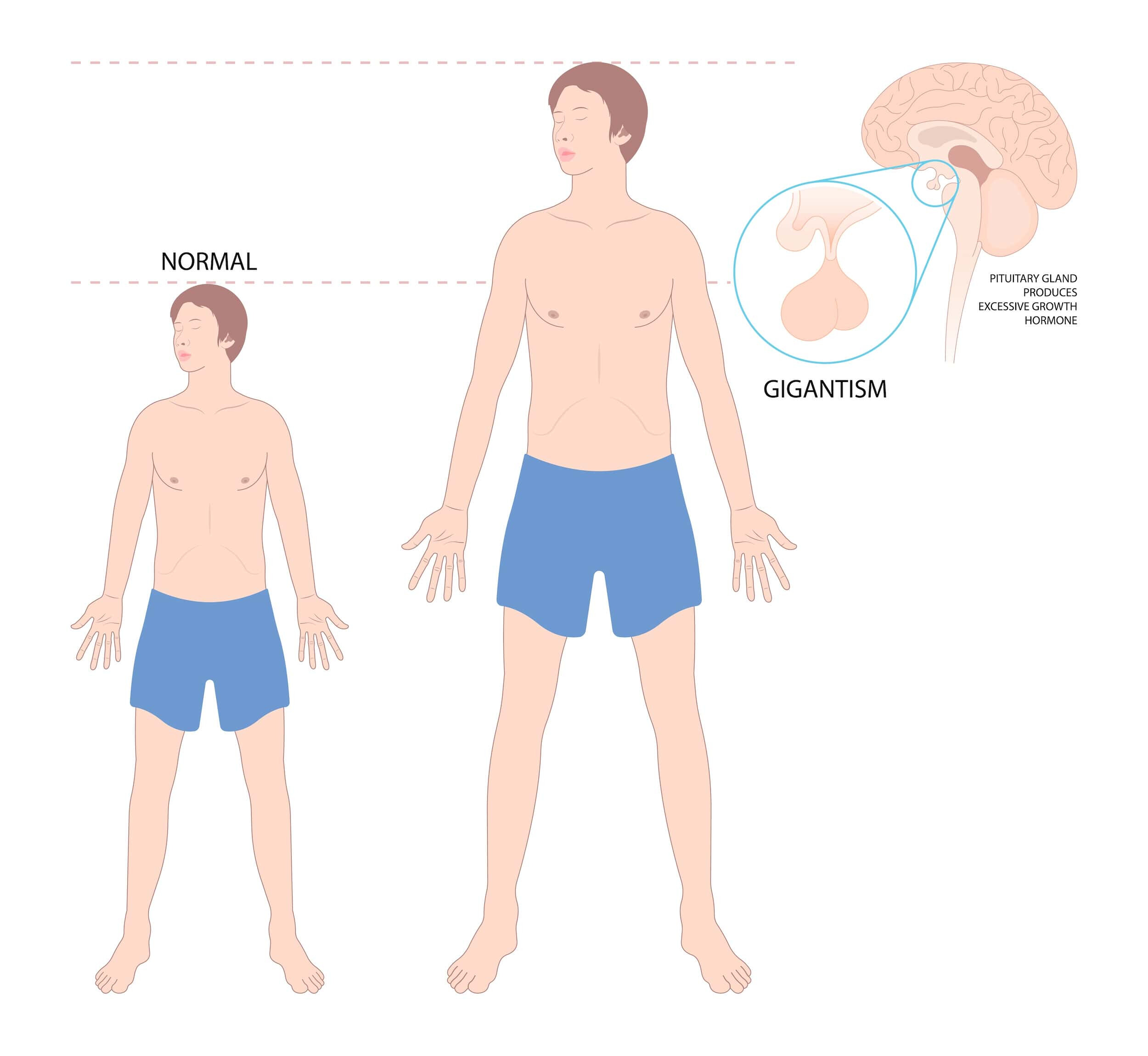 Gigantism Treatment in Turkey | Gigantism Procedure in Turkiye