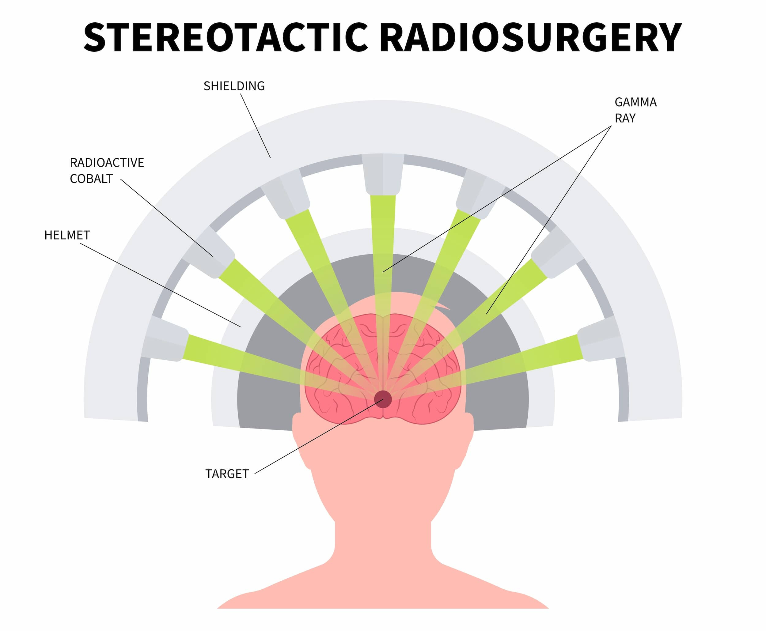Stereotactic Radiosurgery in Turkey | Neurosurgery in Turkey
